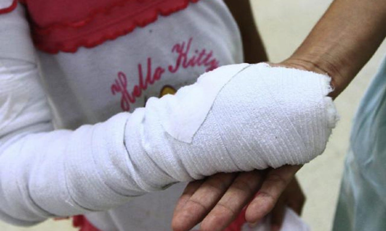 Quemados con pólvora