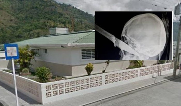 ¡Escalofriante! Un hombre llegó con un cuchillo incrustado en el ojo al hospital de Cajamarca