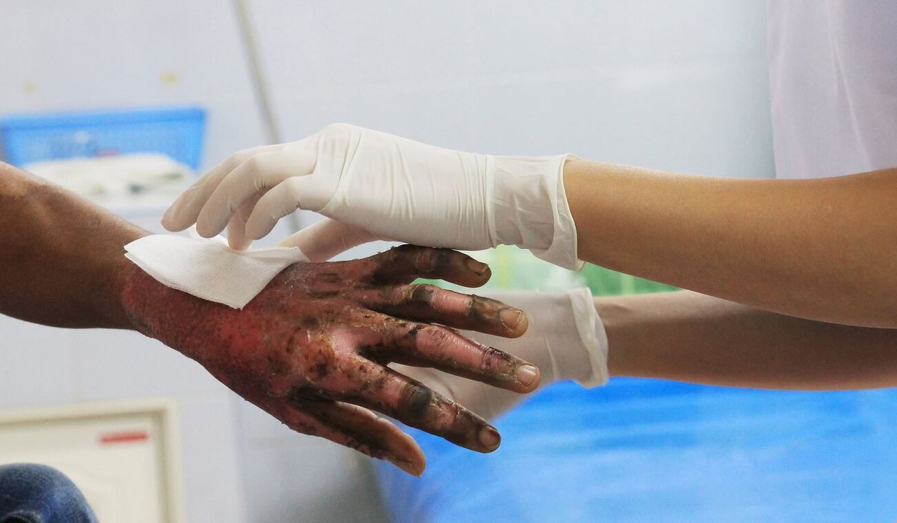 Quemado por pólvora