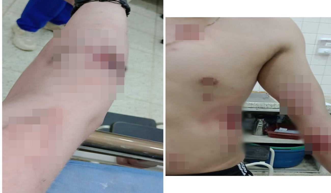 Quemado con pólvora en Palocabildo