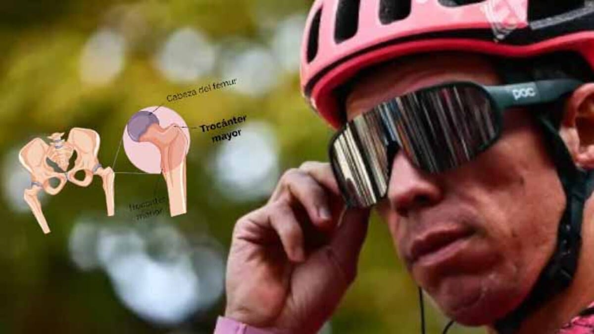 Rigo trocanter mayor