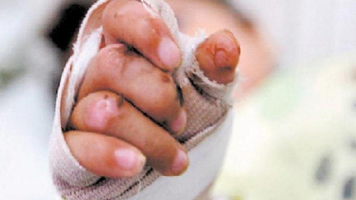 Quemados por pólvora en Antioquia