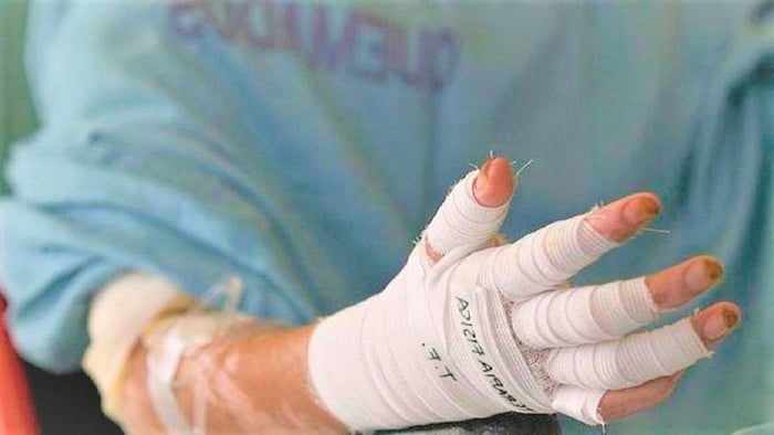 A 95 aumentó la cifra de personas quemadas con pólvora en Antioquia