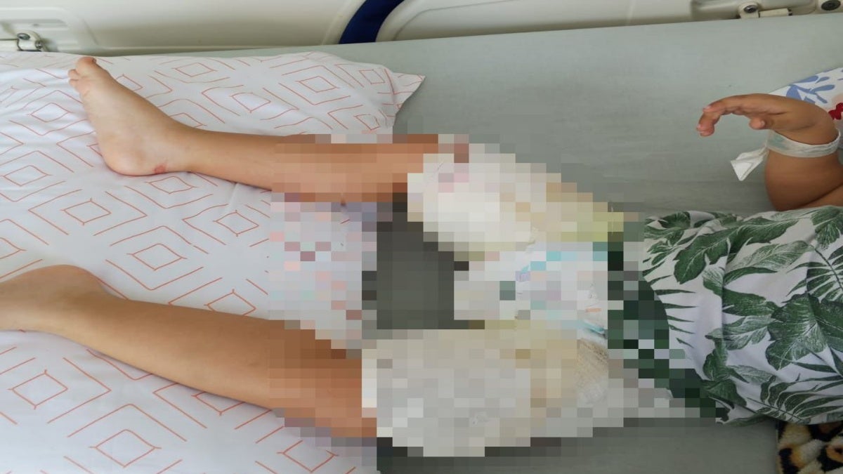 Bebé quemado Ibagué