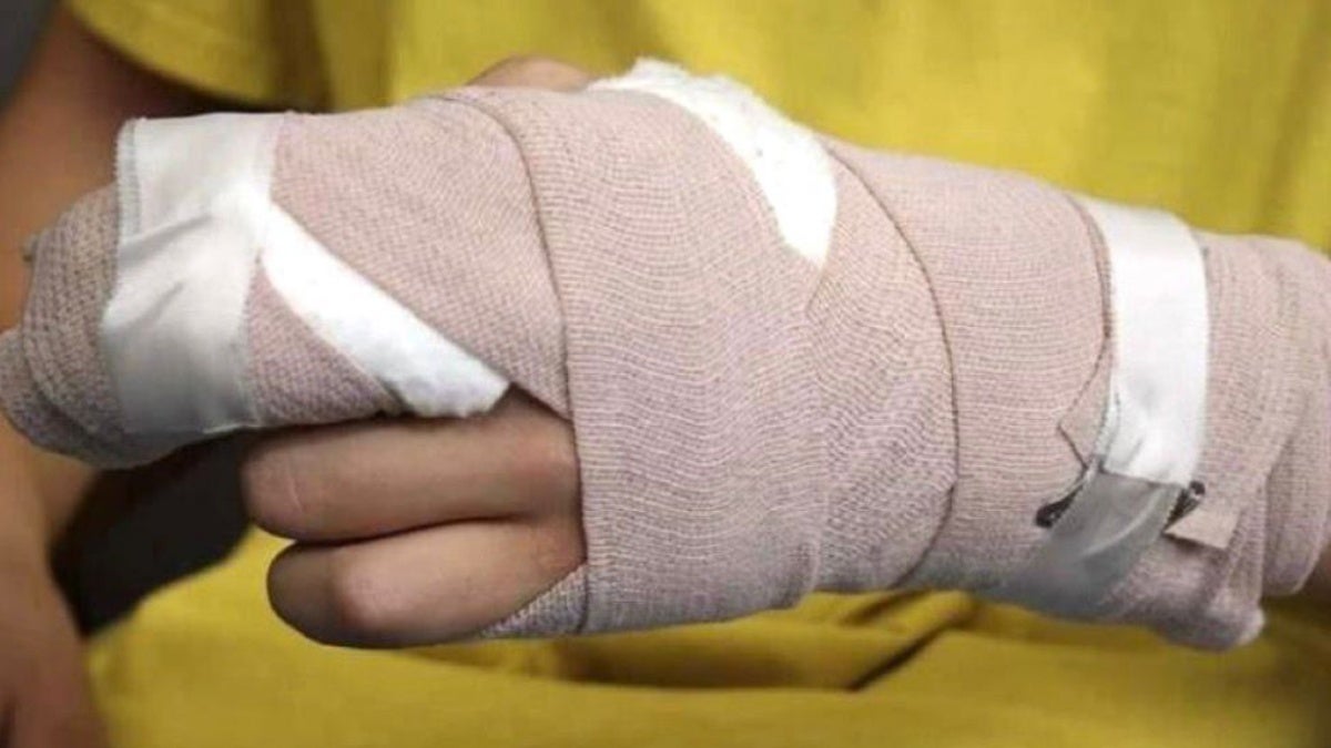 Quemados con pólvora Ibagué