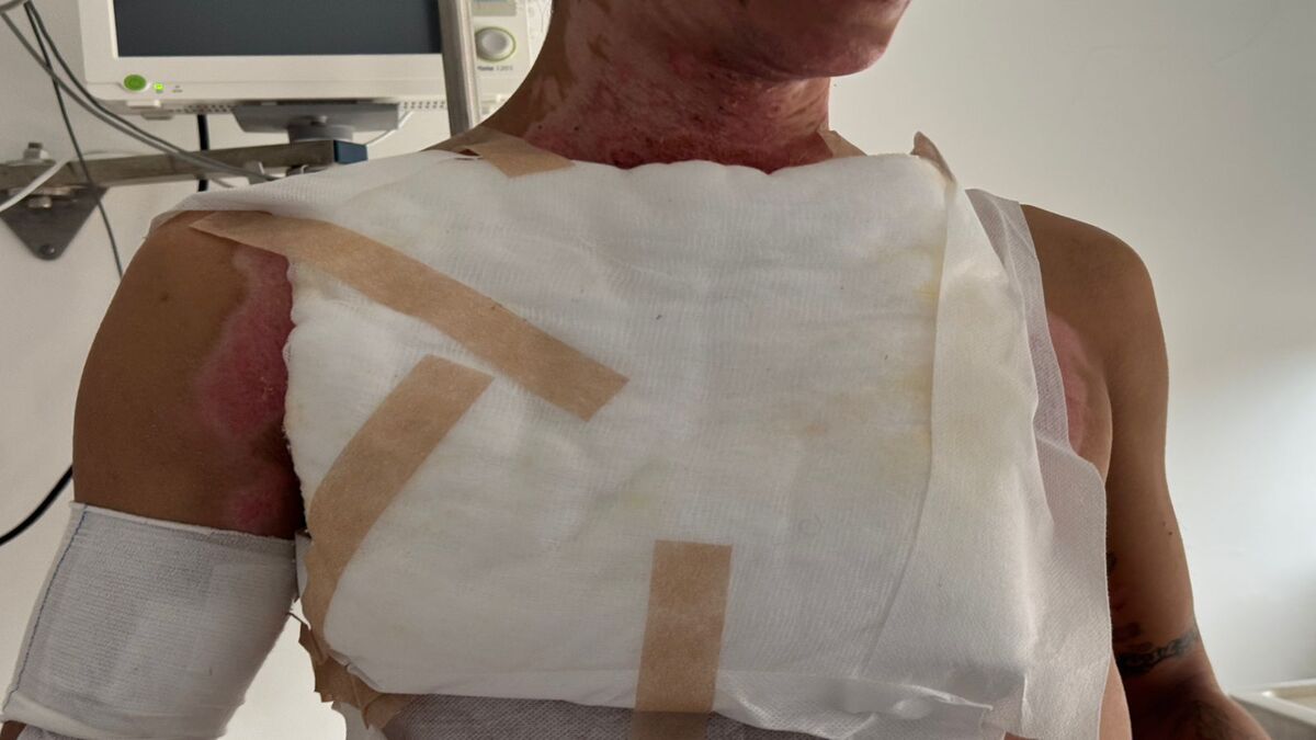 Quemados con pólvora | Pólvora | Quemaduras | Diciembre 2025