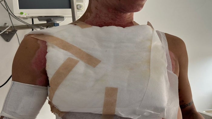 Quemados con pólvora | Pólvora | Quemaduras | Diciembre 2025