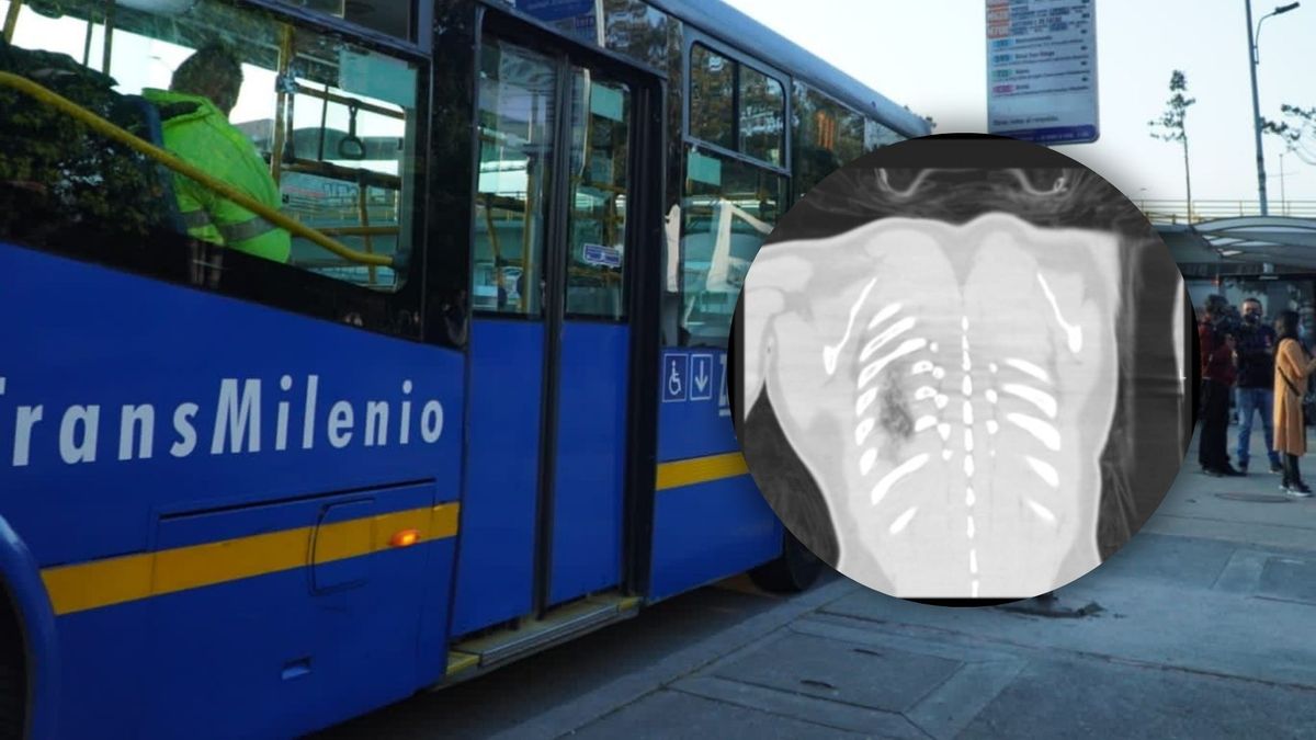 Bus de SITP y radiografía de la víctima del incidente
