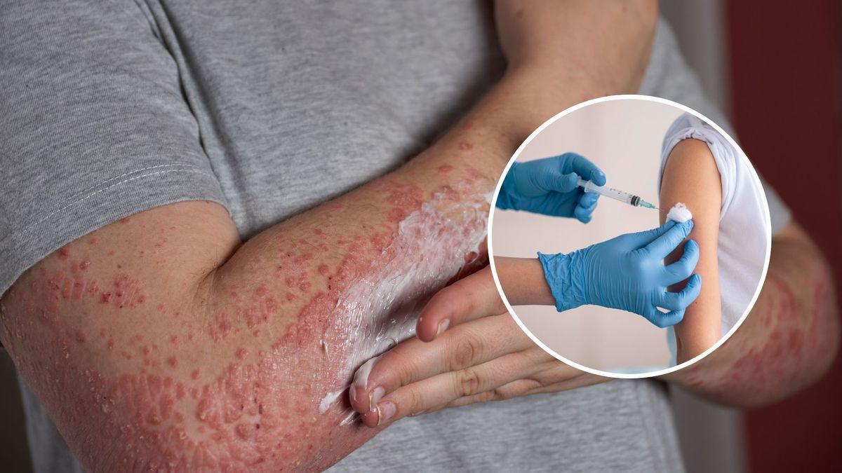 ¿Qué tan peligroso es el sarampión y cuáles son sus síntomas y complicaciones?