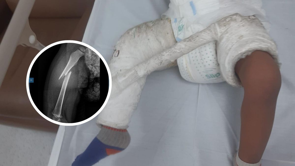 Menor de dos años enyesado por fractura