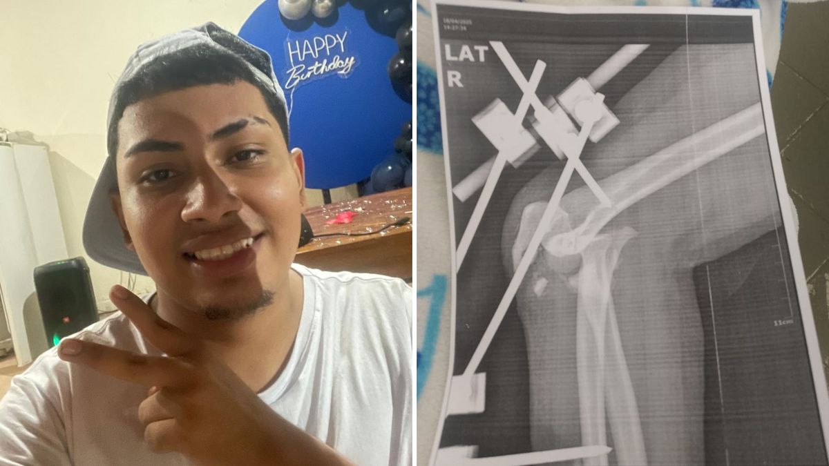 Radiografía de joven accidentado en Brasil